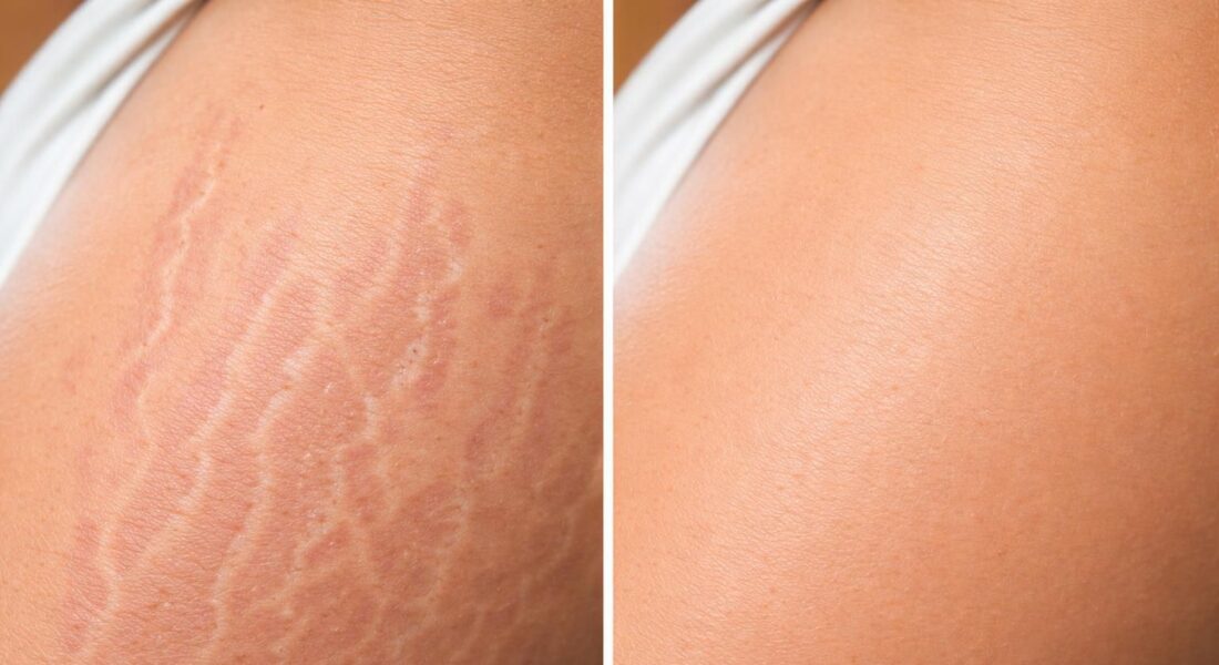 découvrez comment le microneedling et le dermaroller révolutionnent le traitement des vergetures avec des résultats avant/après impressionnants pour une peau transformée et revitalisée.